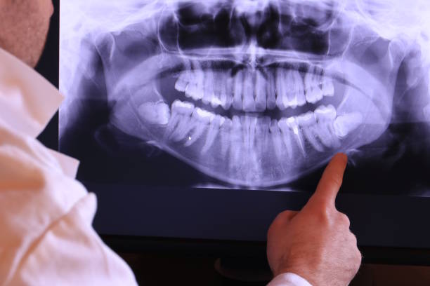 Best Emergency Tooth Extraction in Hodgkins, IL